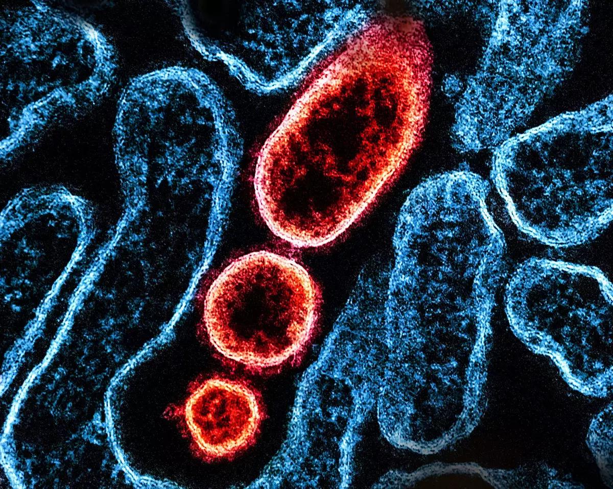 尼帕病毒疫情 西孟加拉邦 尼帕病毒症状_全球疫情